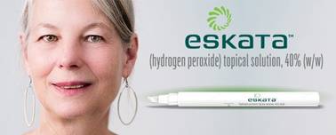 Eskata - FDA approved topical medication for seborrheic keratoses